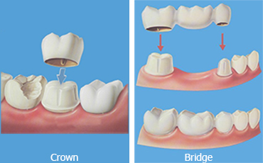 Crowns_Bridges