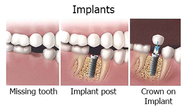 Implants