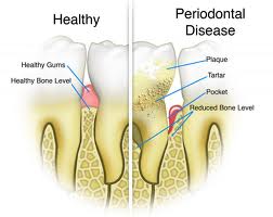 p_disease